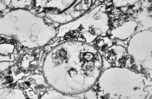 M,50y. | Pneumocystis carinii - lung M,50y. | Pneumocystis carinii - lung